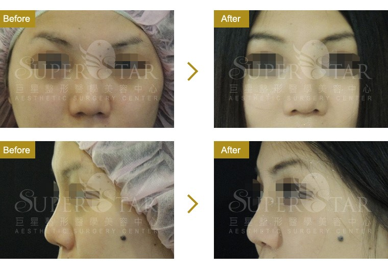 Case5 二段式隆鼻 – 人工骨韓式隆鼻