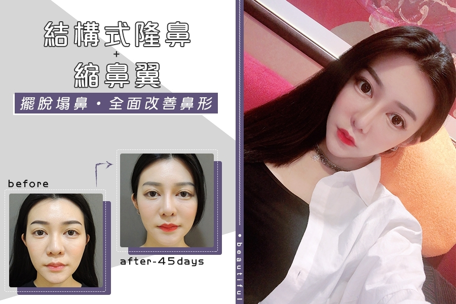 Case6 三段式隆鼻 – 韓式隆鼻, 結構式隆鼻