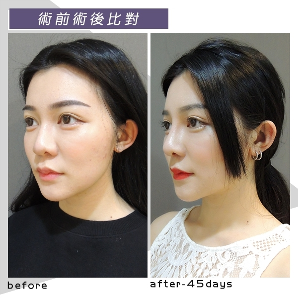 Case6 三段式隆鼻 – 韓式隆鼻, 結構式隆鼻 45天45度角術前術後照