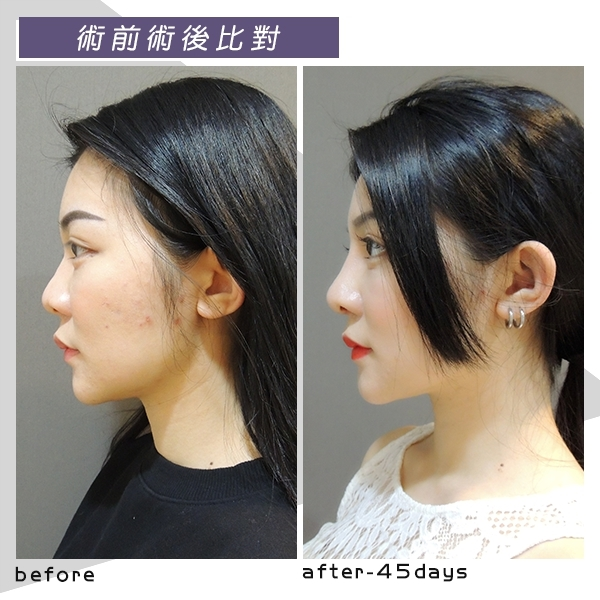 Case6 三段式隆鼻 – 韓式隆鼻, 結構式隆鼻 45天側面術前術後照