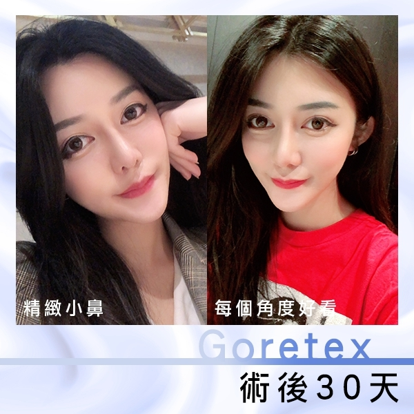 Case6 三段式隆鼻 – 韓式隆鼻, 結構式隆鼻術後30天