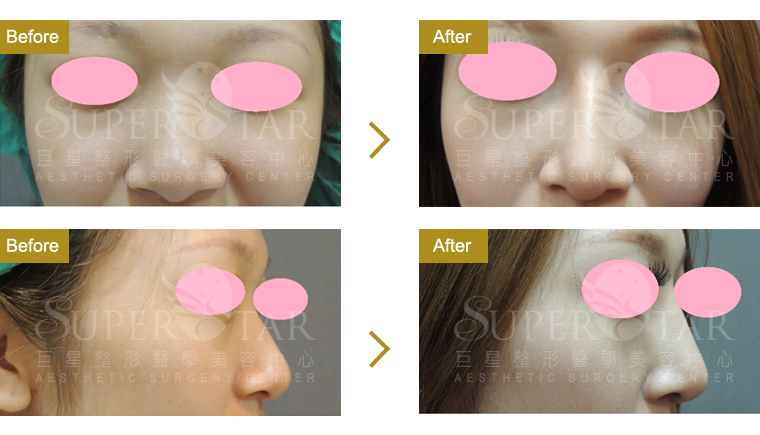 Case7 二段式隆鼻 – 韓式隆鼻