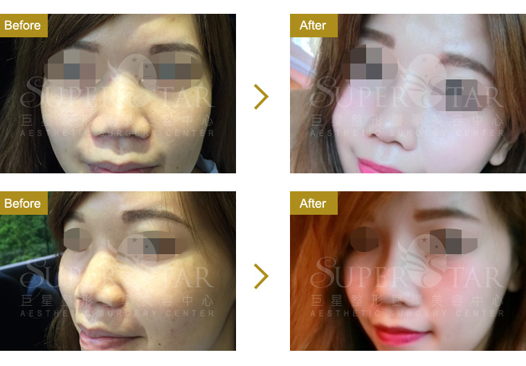 Case8 二段式隆鼻