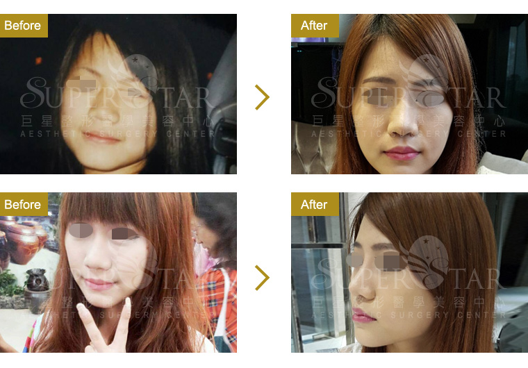 Case9 二段式隆鼻 – 人工骨韓式隆鼻