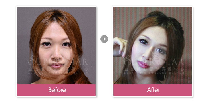 Case10 二段式隆鼻 – 韓式隆鼻