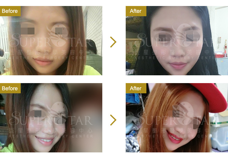 Case11 三段式隆鼻 – 韓式隆鼻