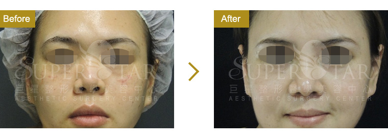 Case12 三段式隆鼻－進階版韓式隆鼻 正面照