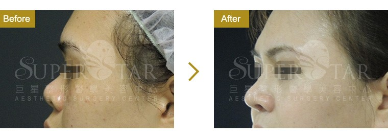 Case12 三段式隆鼻－進階版韓式隆鼻  側面照