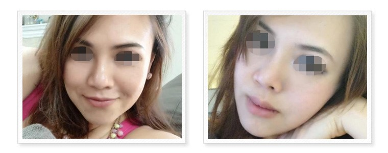 Case12 三段式隆鼻－進階版韓式隆鼻 術後生活照