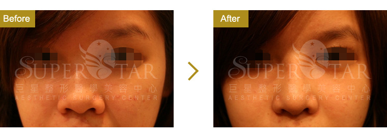 Case13 二段式隆鼻