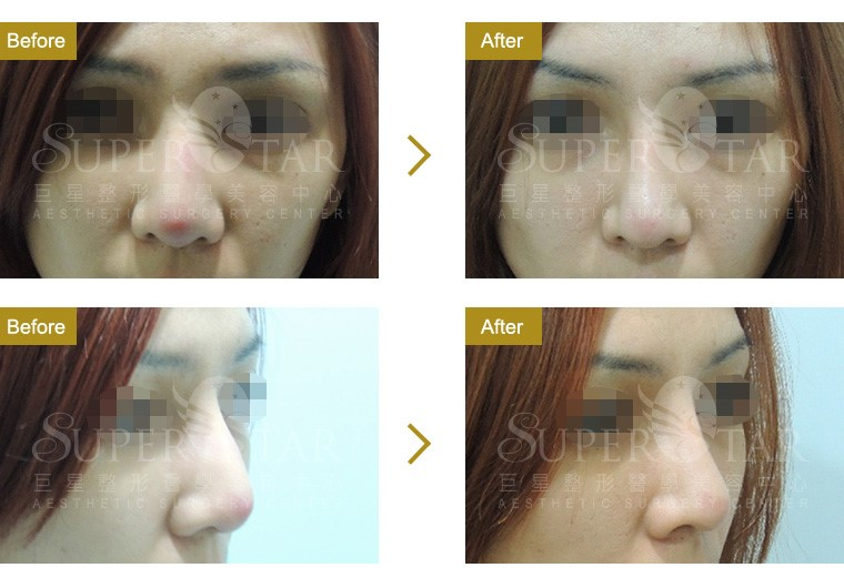 Case14 二次鼻整形 - 隆鼻重修