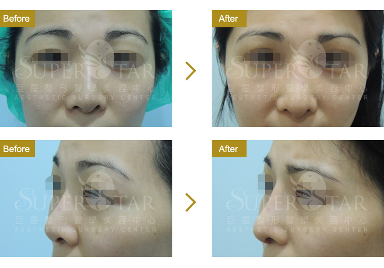 Case15 二次鼻整形 - 隆鼻重修