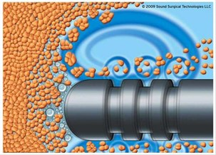 威塑抽脂：深抽淺雕，力求體態雕塑完整度