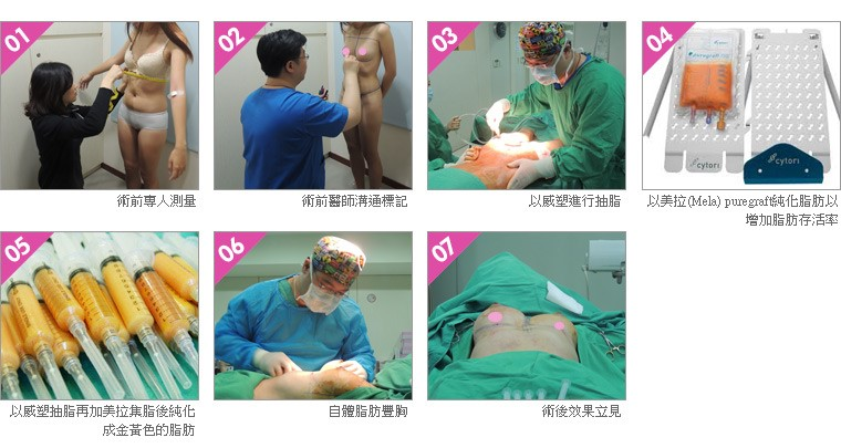 自體脂肪隆乳 手術流程紀錄