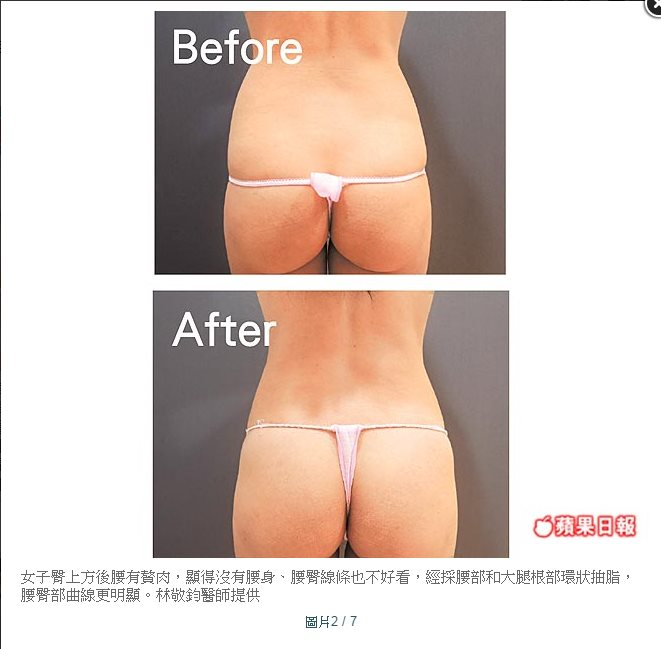 臀部前後對比圖