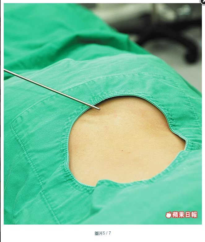 威塑抽脂 (超音波氣泡效應)手術照