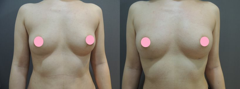 術後前後對比照