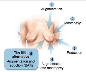 五種解決乳房下垂的手術策略