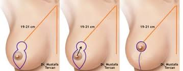 (上圖：同心圓切口，適合輕度)