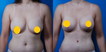 案例一：垂直切口提乳1