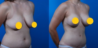 案例一：垂直切口提乳2