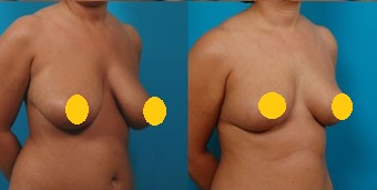 案例三：倒 T 形切口提乳（針對重度下垂）2