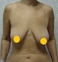 案例四：倒 T 形切口提乳術前1