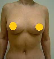 案例四：倒 T 形切口提乳術後1