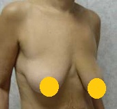 案例四：倒 T 形切口提乳術前2