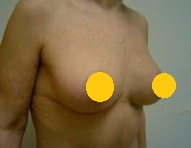 案例四：倒 T 形切口提乳術後2