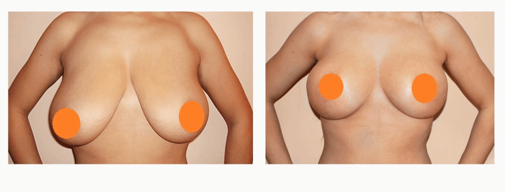 案例六：縮乳手術1