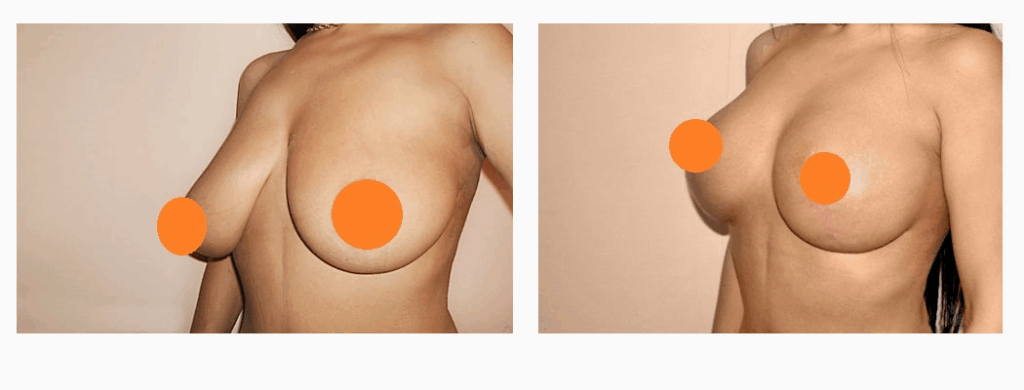 案例六：縮乳手術3