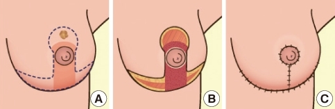 倒 T 型縮乳手術 (Inverted-T / Wise Pattern)