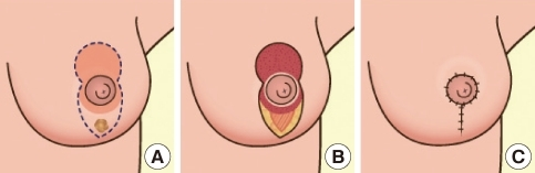  I 型縮乳 / 垂直切口縮乳 (Vertical / Lollipop) —— 台灣女性首選 👍