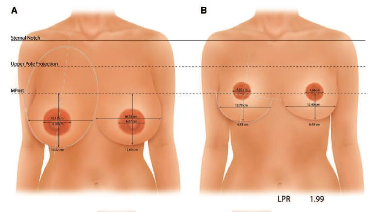  正面胸型比較-垂直切口縮乳