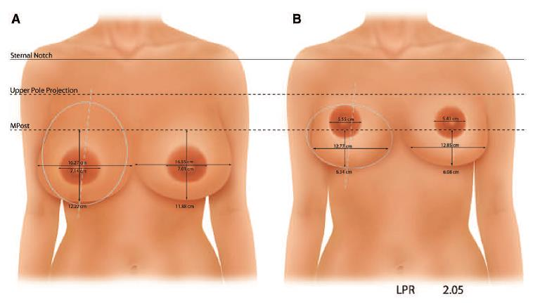 上圖：倒T縮乳 - 胸型較寬平