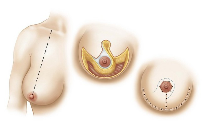 3. 倒T切口縮乳 - 內上血管莖 (Superiomedial Pedicle)