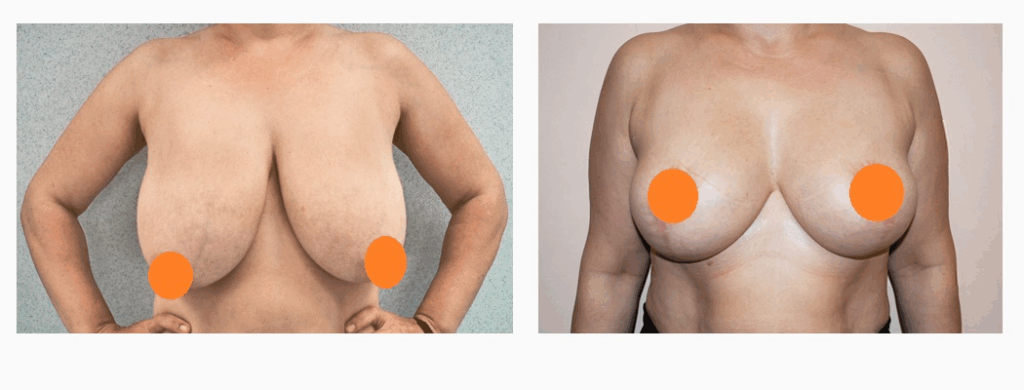 案例二：倒T型縮胸手術 (改善外擴與平坦胸型)術前術後照