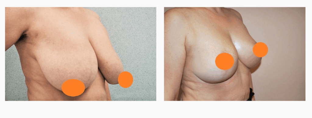 案例二：倒T型縮胸手術 (改善外擴與平坦胸型)側面術前術後照