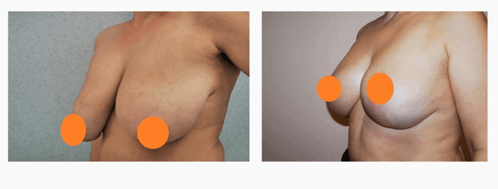 案例二：倒T型縮胸手術 (改善外擴與平坦胸型)45度角術前術後照