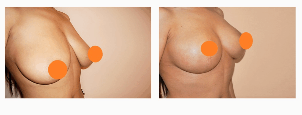 案例三：倒T型縮乳 (巨乳症矯正)術前術後照2
