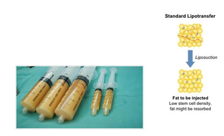 自體脂肪豐頰手術