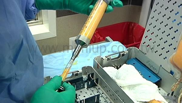 (二) 精密純化：將脂肪離心純化後，分裝至 1ml 針筒，確保注射精準度。