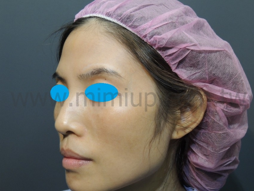 <術前：臉頰凹陷明顯>側面