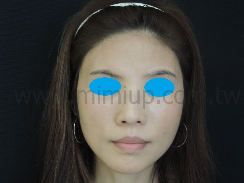 術後 1.5 個月：線條柔順飽滿>正面照