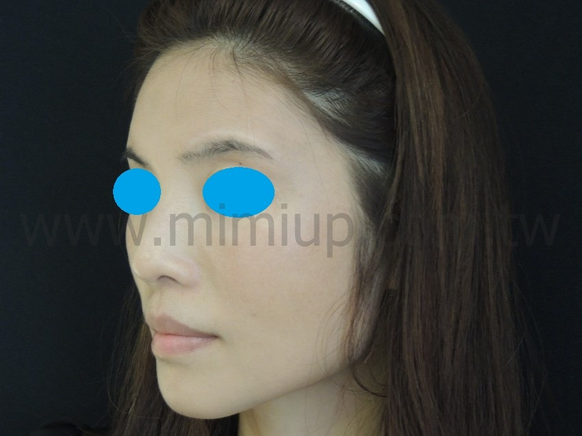 術後 1.5 個月：線條柔順飽滿>側面照