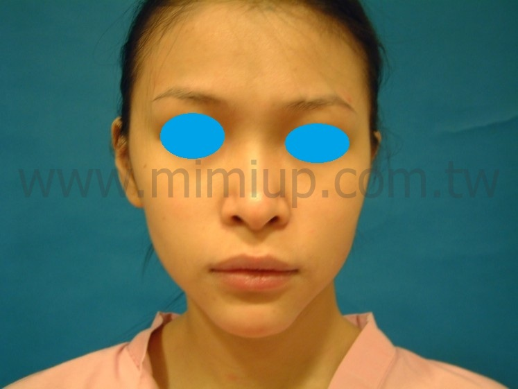 案例二：自體脂肪豐蘋果肌，打造甜美氣色術前