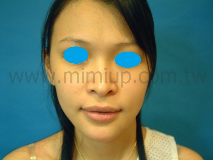 案例二：自體脂肪豐蘋果肌，打造甜美氣色術後