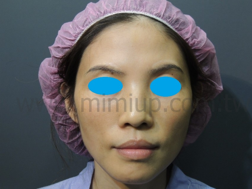 <術前：頰凹陷明顯>正面