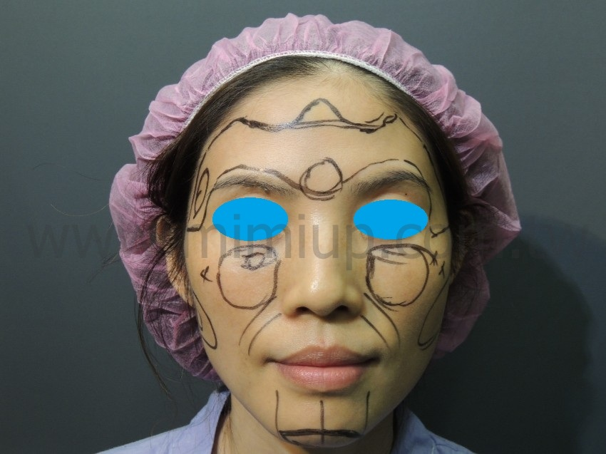 <手術過程：以自體脂肪做全臉補脂>1